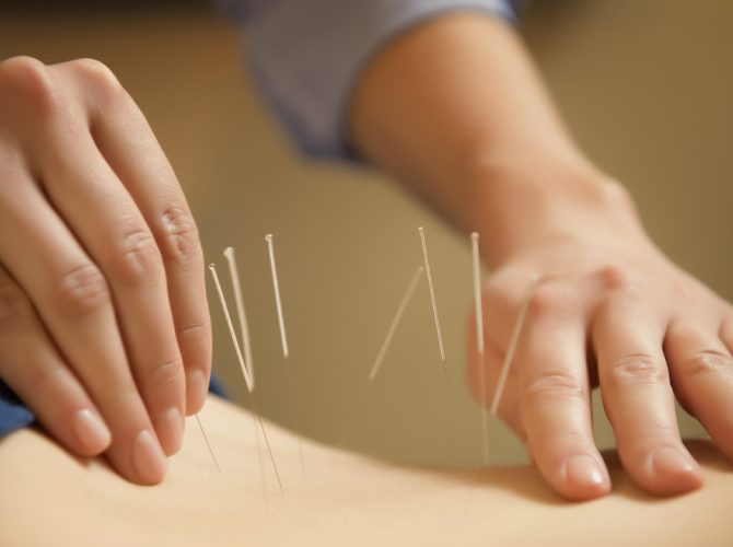 Pain relief acupuncture at Balance Healthcare